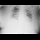 Lung edema, before and after therapy: X-ray - Plain radiograph